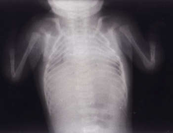 X-ray chest with both upper limbs showing single forearm bone and single finger in each hand.