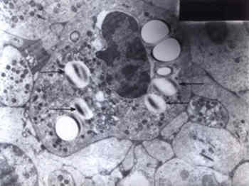 Fig. 2. Electron micrograph (� 6000)_The buffy coat reveals neutrophils showing large cytoplasmic vacoules containing osmiophilic material (arrows). 