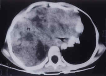 CT scan showing the tumor mass (M) in the right hemithorax