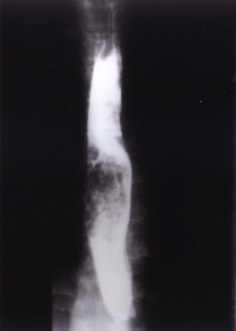 Barium swallow demonstrating mottled filling defects expanding the esophageal lumen