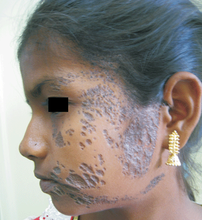 epidermal nevus face