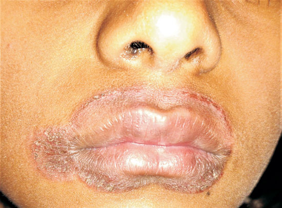 Lip Smacker's Cheilitis