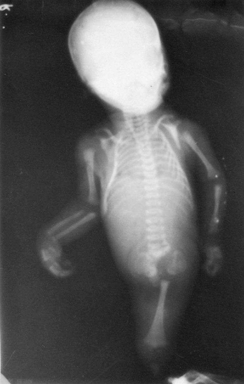 sirenomelia syndrome x ray