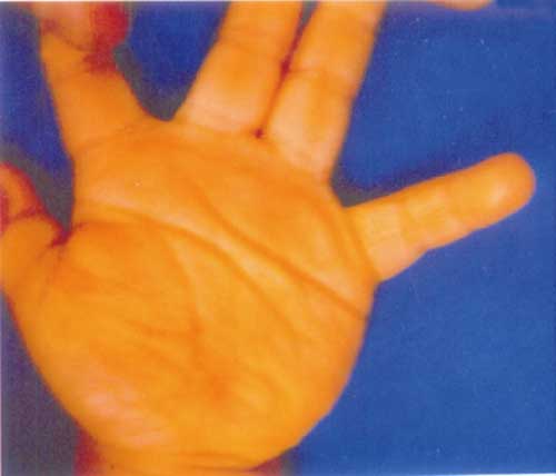Orange discoloration of the palms