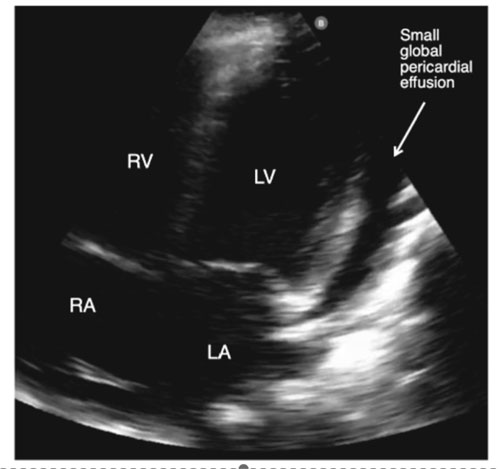 Incomplete Kawasaki Disease in a Child with Covid-19