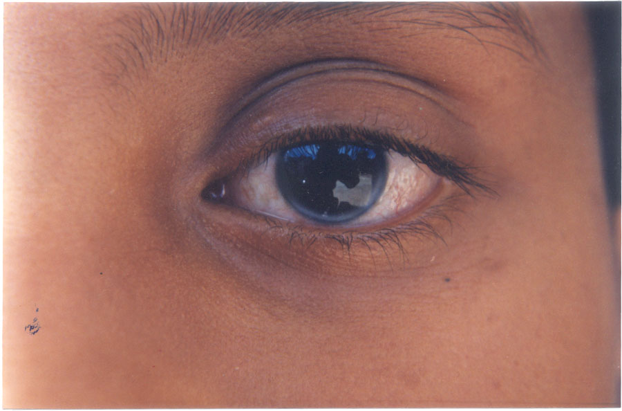 Corneal Arcus