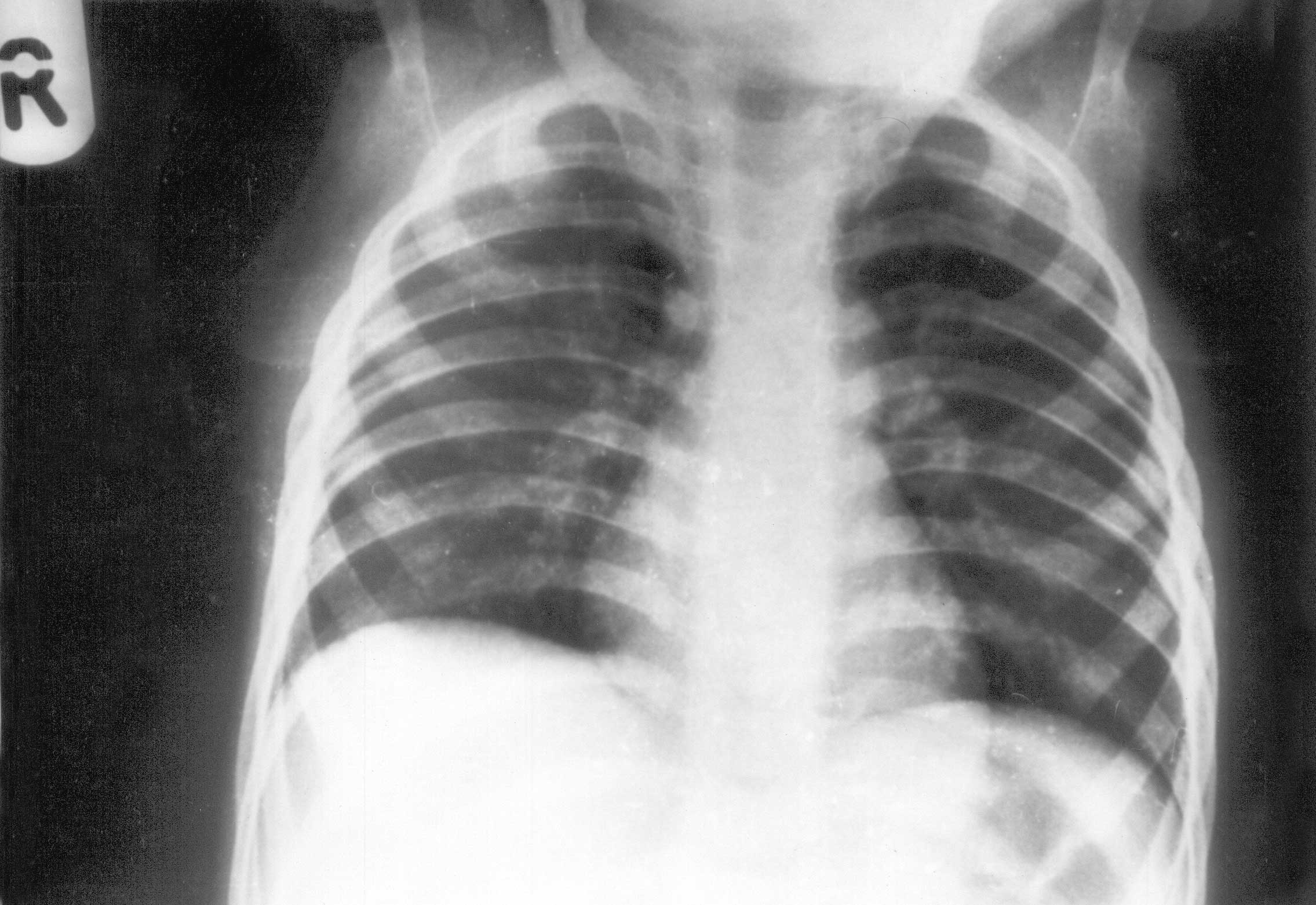 Врожденный туберкулез рентген