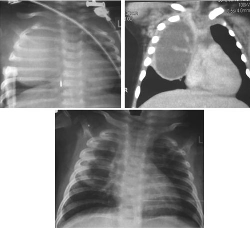 lung abscess x ray