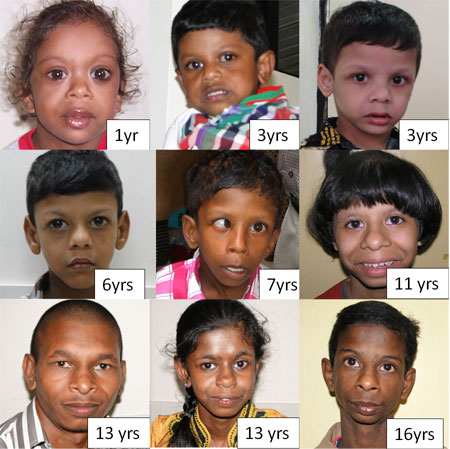 Williams Syndrome A Case Series