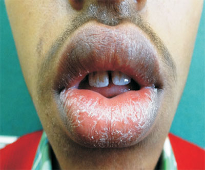 infectious cheilitis