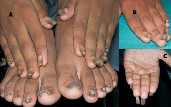 Nail Dystrophy With Ridging and Roughness - Clinical Advisor