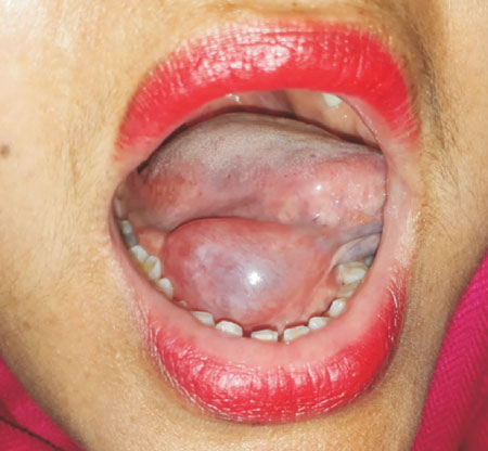 Cystic Swelling In The Floor Of Mouth